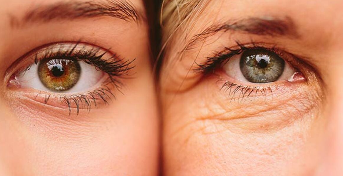 Uitwendige tekenen van huidveroudering rond de ogen bij twee vrouwen van verschillende leeftijden