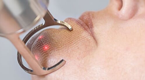 Het verloop van de procedure voor fractionele laserverjonging van de gezichtshuid